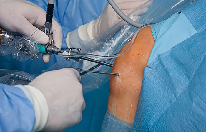 Knee Arthroscopy